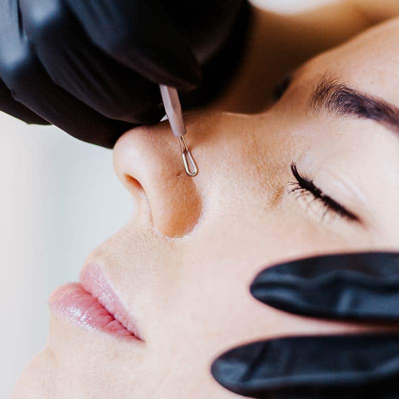 Acne Treatments for Clear Skin at Arsenault Aesthetics in Lakewood Ranch FL