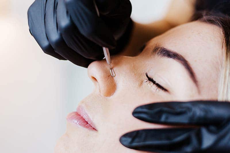 Acne Treatments for Clear Skin at Arsenault Aesthetics in Lakewood Ranch FL