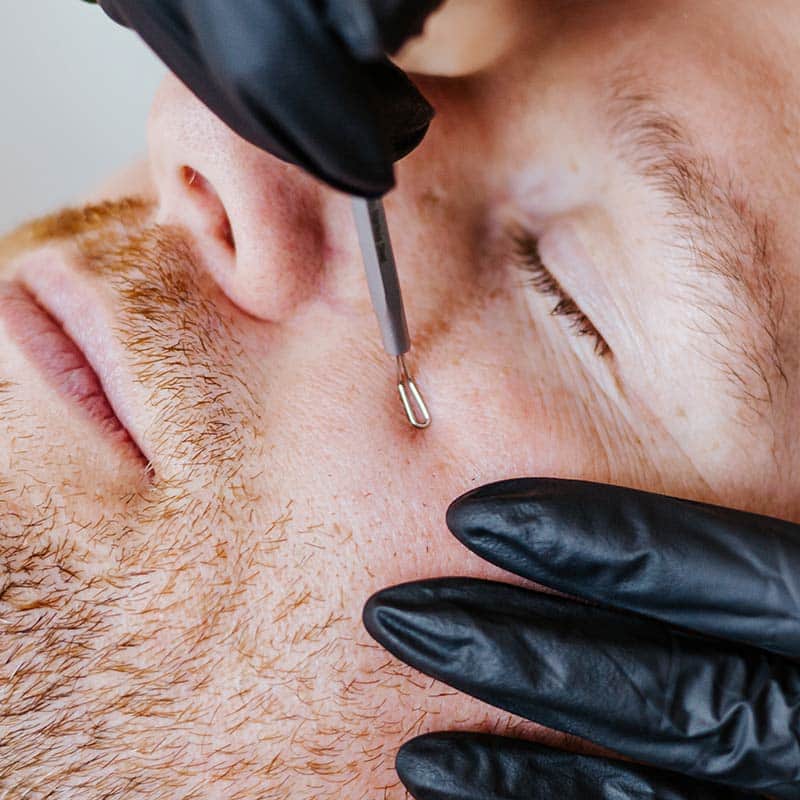 Acne Treatments for Men at Arsenault Aesthetics.jpg