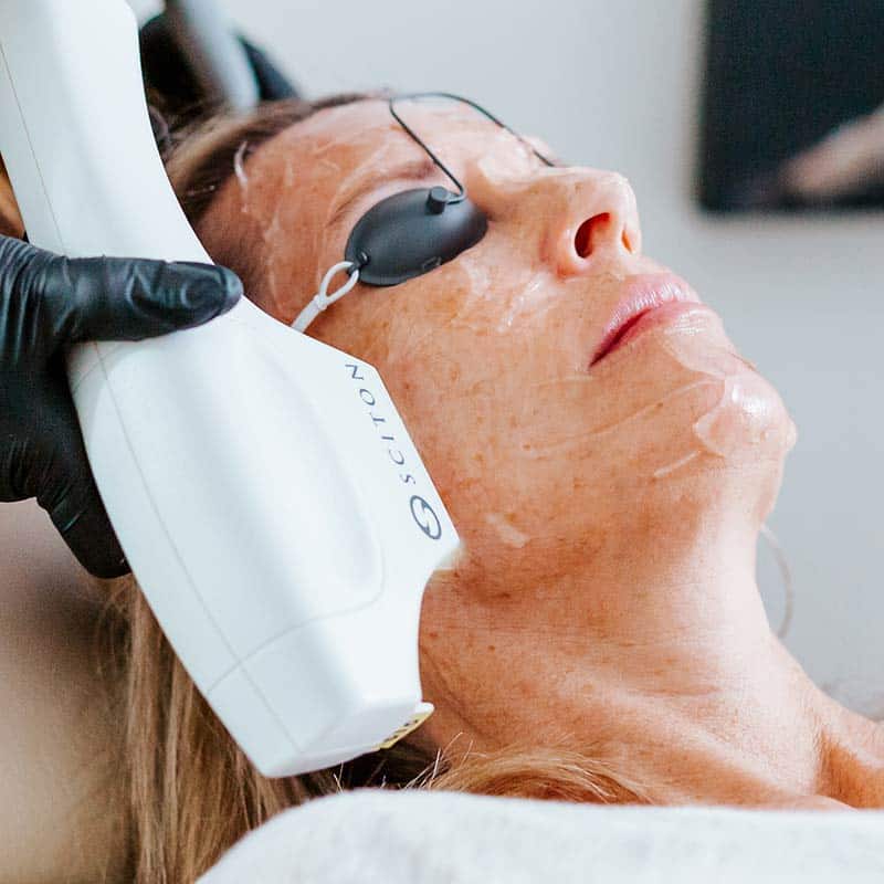 BBL Photofacial Laser Treatment for Skin Health at Med Spa in Lakewood Ranch FL - Arsenault Aesthetics