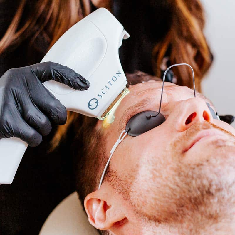 BBL Photofacial Laser Treatments For Skin Health for Men at Arsenault Aesthetics