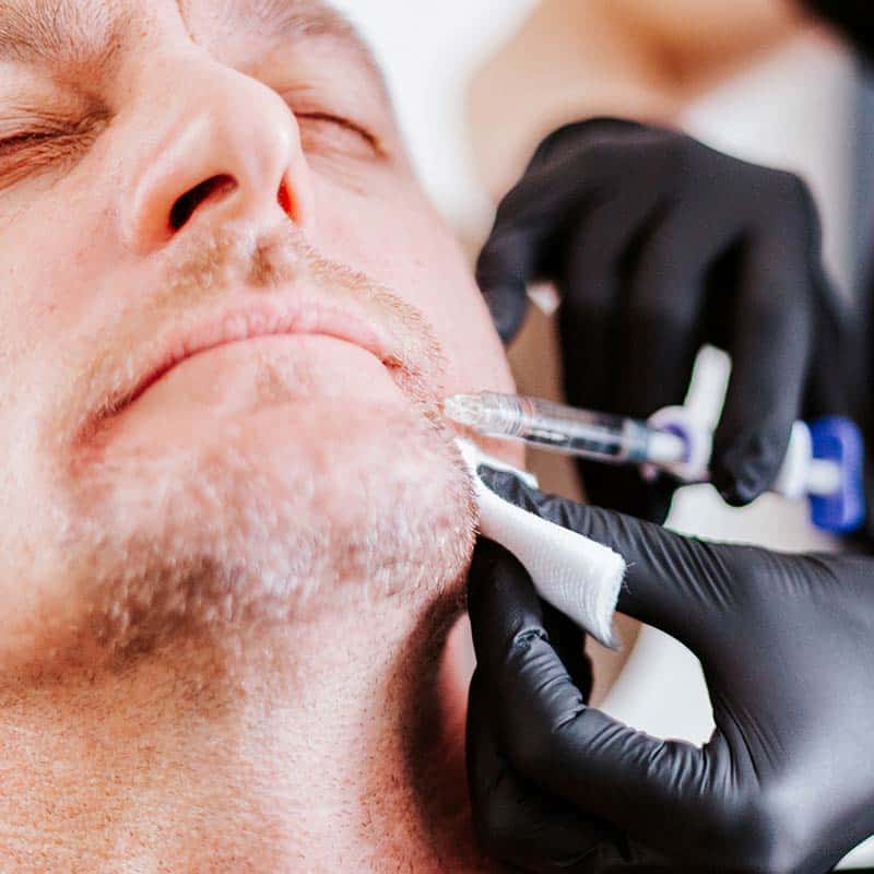 Lip Filler and Dermal Fillers Treatment for Men at Arsenault Aesthetics in Lakewood Ranch FL