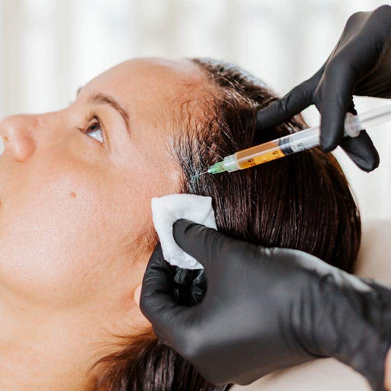 PRF Injections for Hair Restoration and Hair Loss at Arsenault Aesthetics in Lakewood Ranch FL