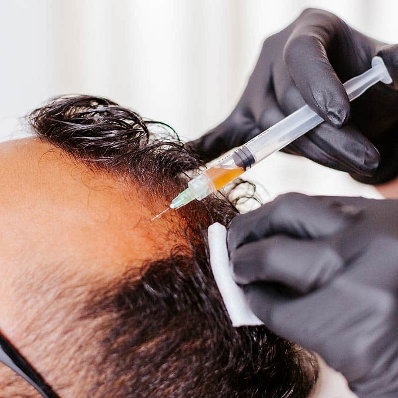 PRF for Hairloss treatments for men for Alopecia at Arsenault Aesthetics in Lakewood Ranch FL