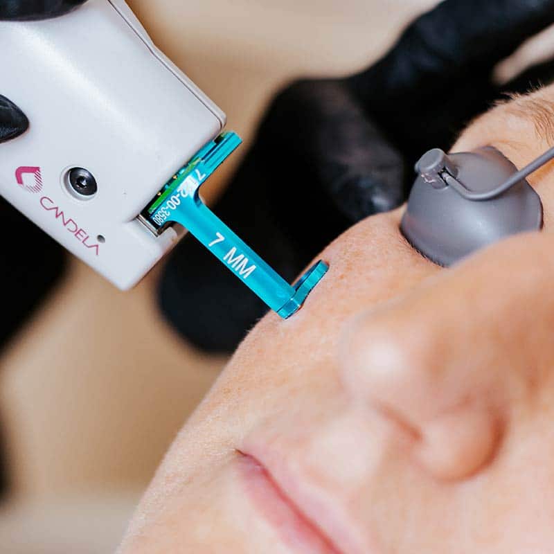 VBeam PDL Laser Pulsed Dye Laser Treatment at Arsenault Aesthetics in Lakewood Ranch FL