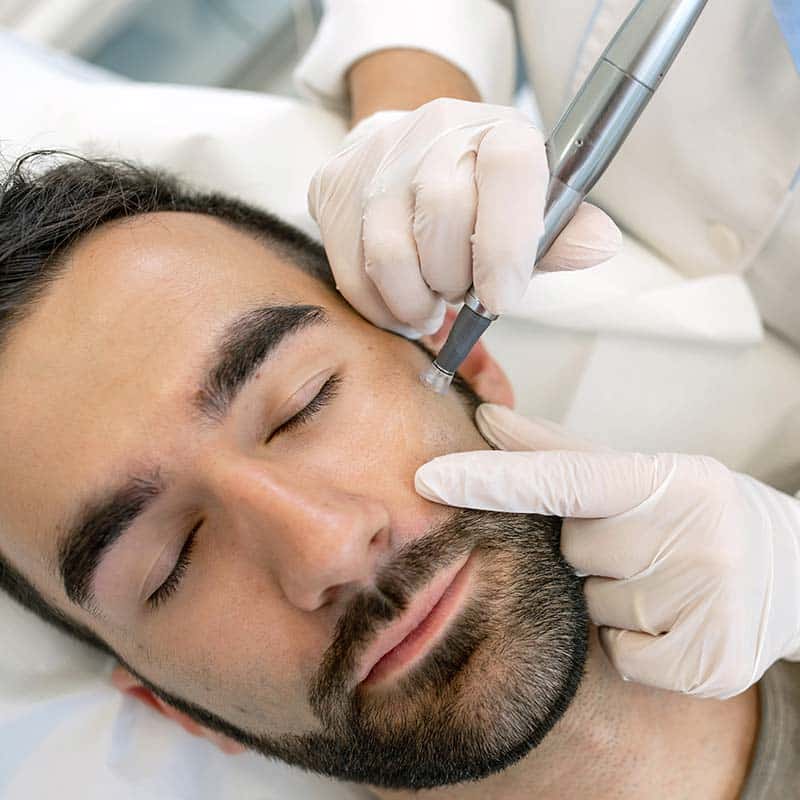 Microneedling chemical peels facials for men at glow dermspa medspa in sarasota bradenton and lakewood ranch florida