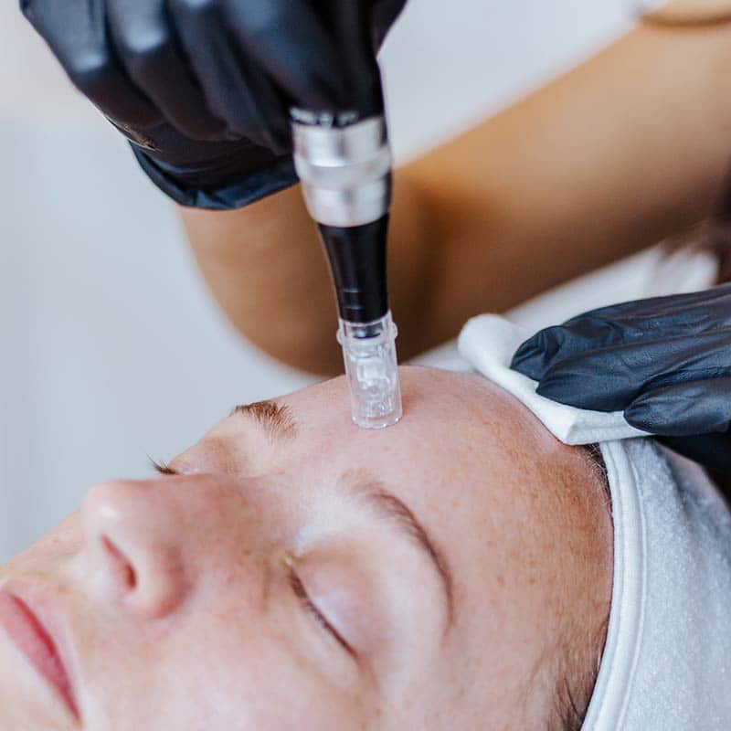 microneedling treatment for skin rejuvenation at Arsenault Aesthetics in Lakewood Ranch