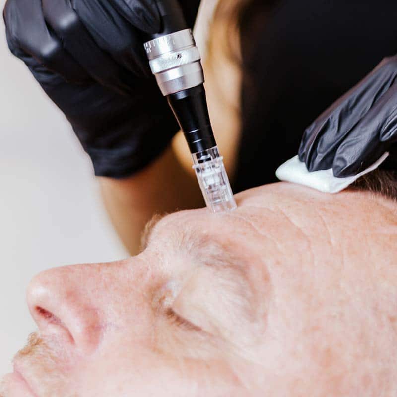 microneedling with PRF treatments for skin rejuvenation for men at glow dermspa in lakewood ranch.jpg