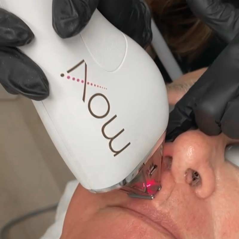 MOXI Laser Treatments and MOXI laser with BBL at Arsenault Aesthetics in Lakewood Ranch Florida