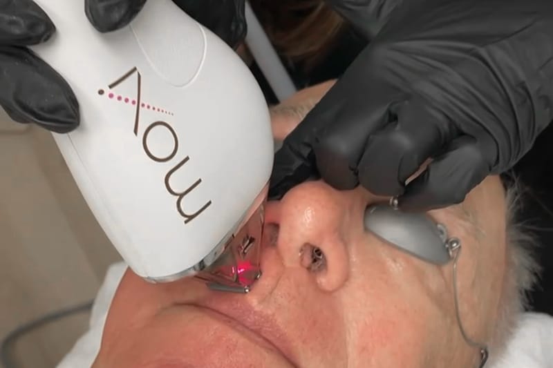 Moxi Laser Treatments at Arsenault Aesthetics in Lakewood Ranch Florida