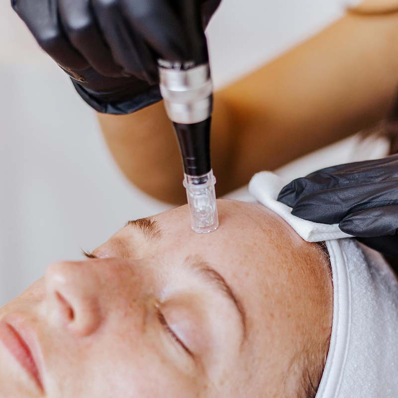 microneedling treatment for skin rejuvenation at Arsenault Aesthetics in Lakewood Ranch