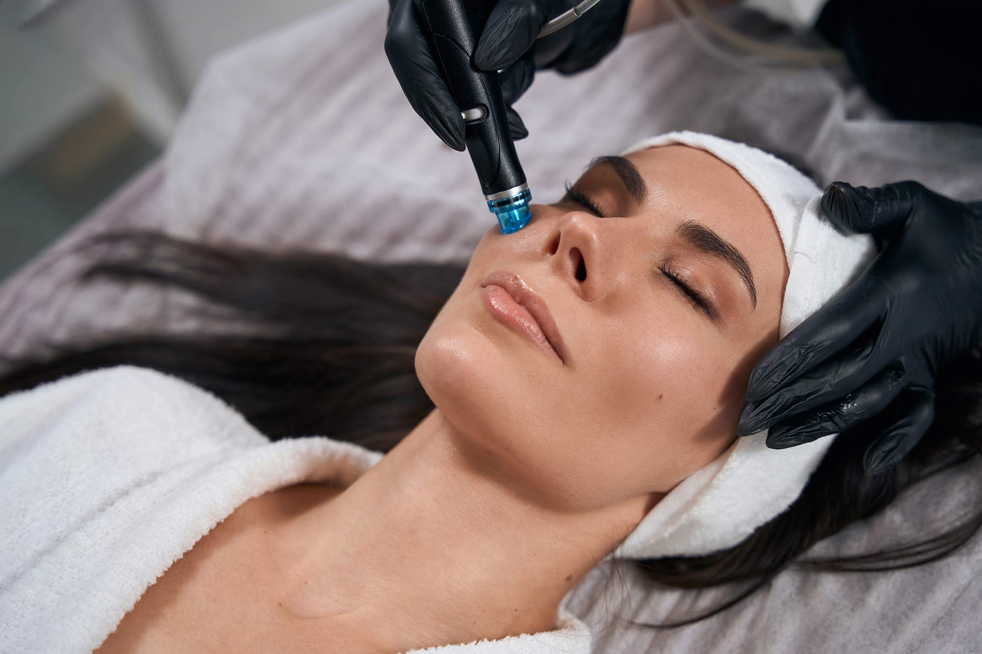 Microneedling