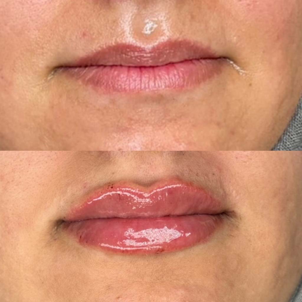 Lip Filler Before & After with Medium Volume