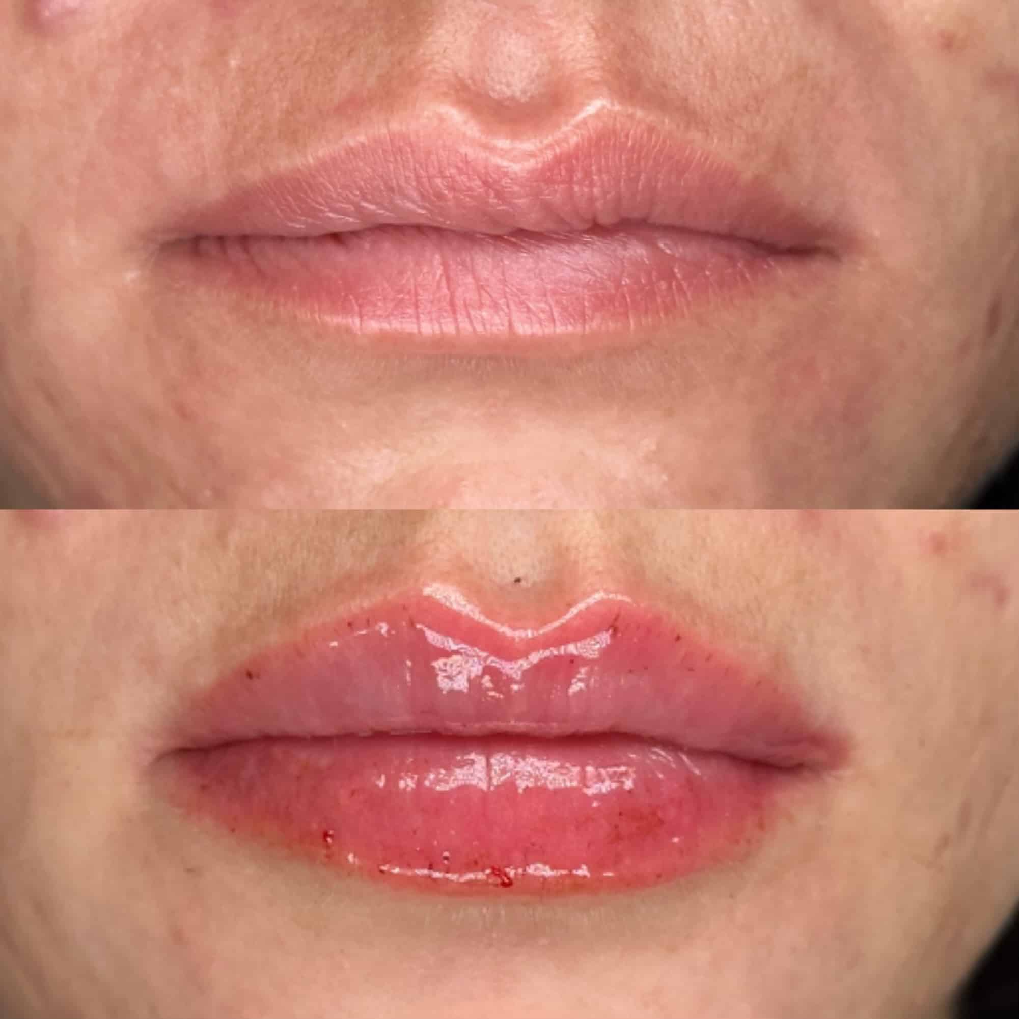 Lip Filler Before and After Example of Big Plump Lips