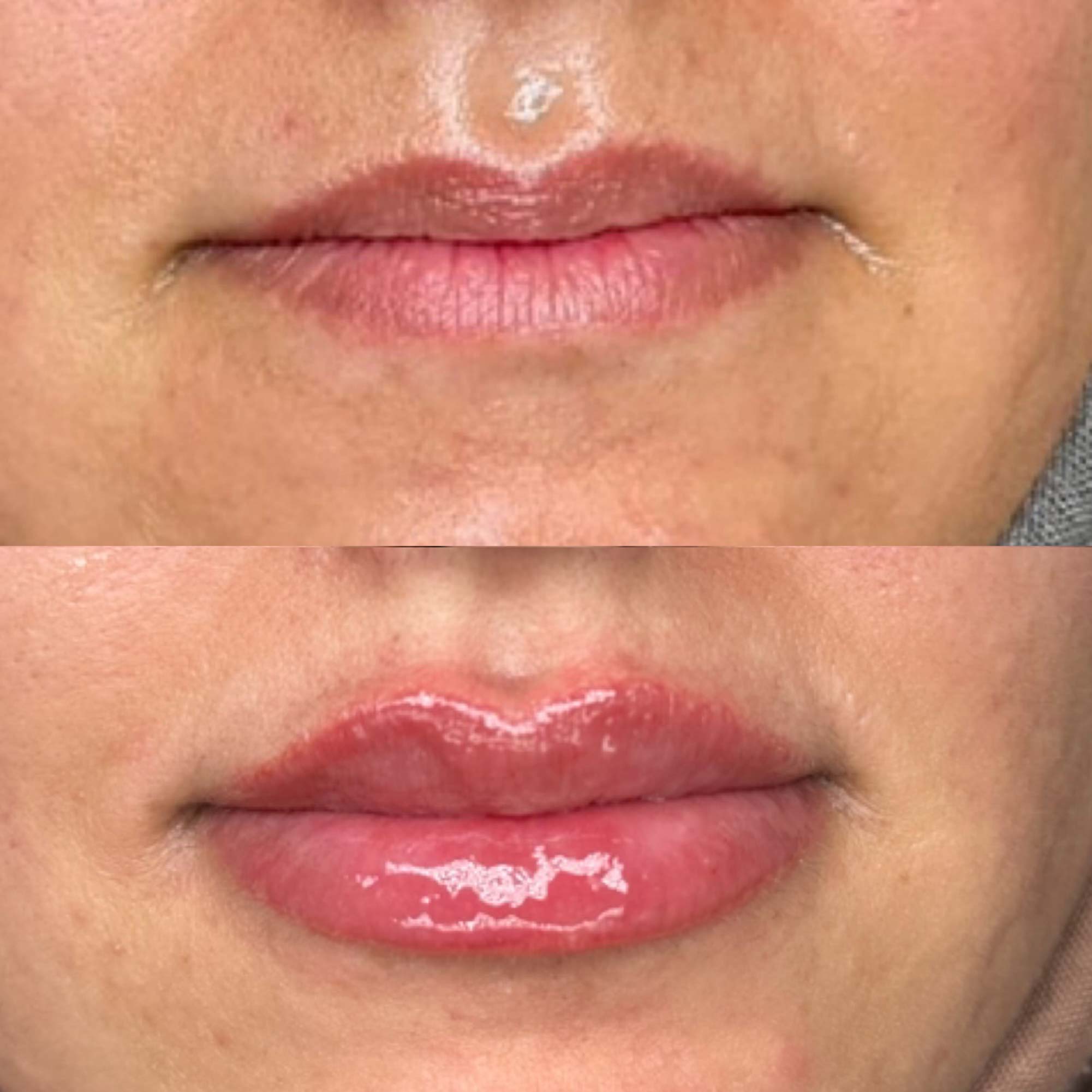 Lip Filler Before and After Example of Big Plump Lips