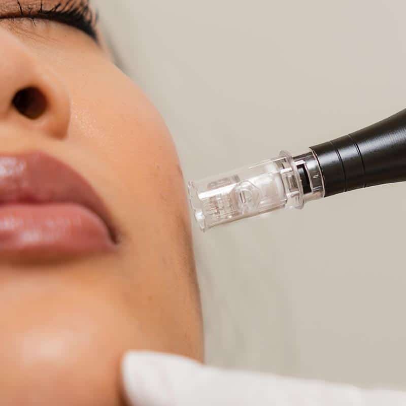 microneedling with exosomes in Lakewood Ranch and Venice FL