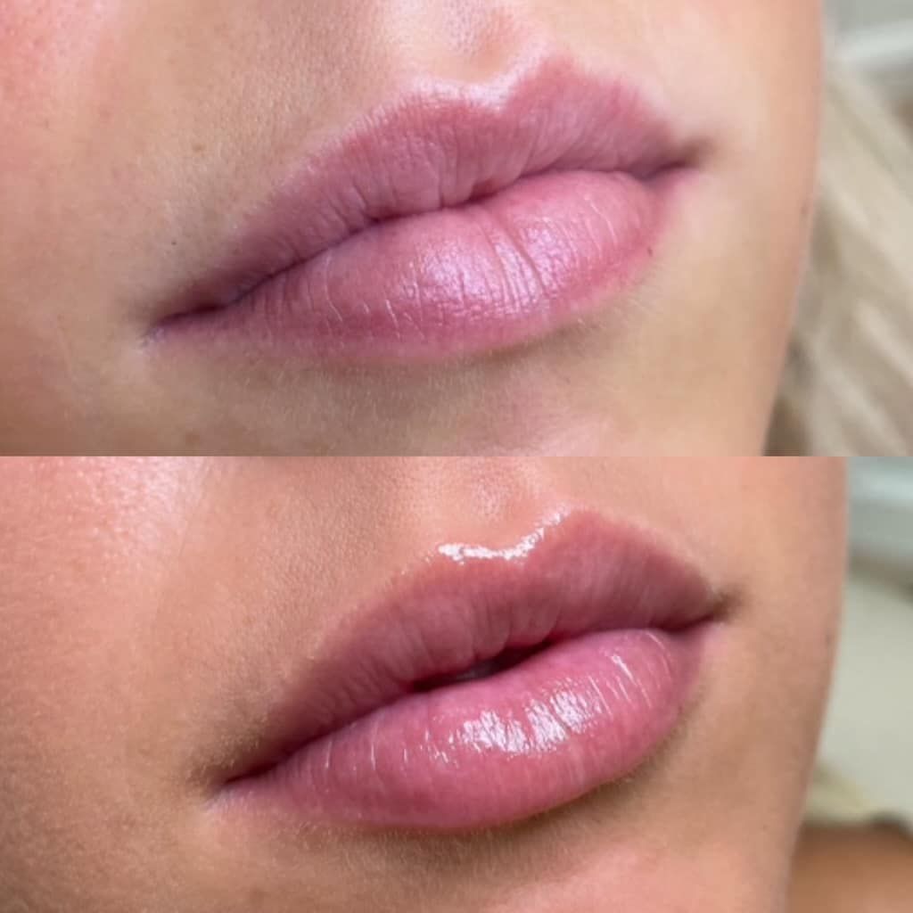 Lip Filler Example