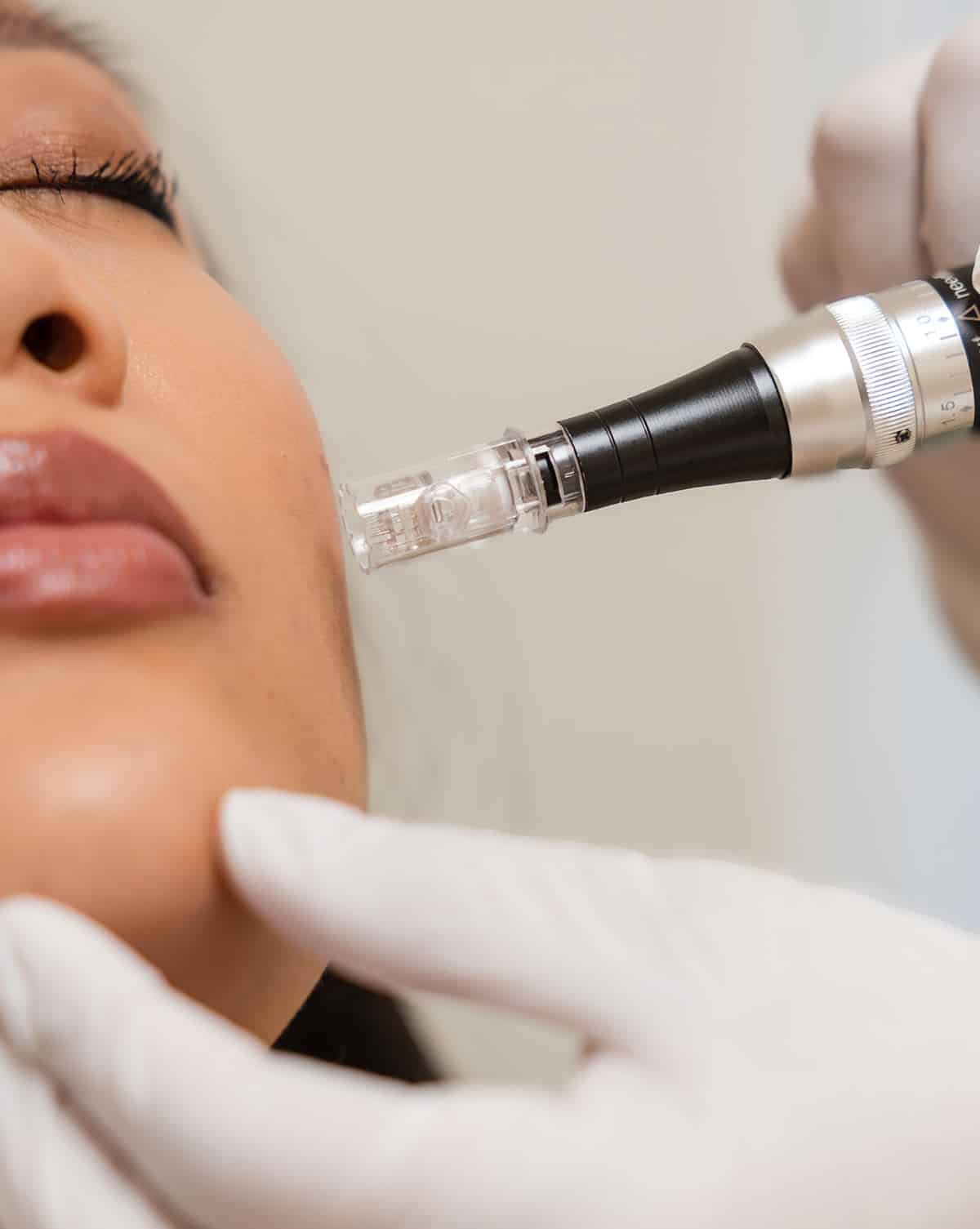 professional microneedling treatment at arsenault aesthetics