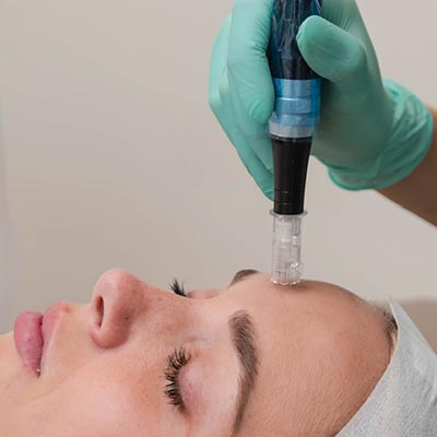 Microneedling in Lakewood Ranch Florida