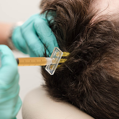 PRF hair restoration therapy at Venice med spa