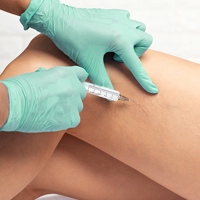 Sclerotherapy spider vein removal treatment at North Lakewood Ranch med spa