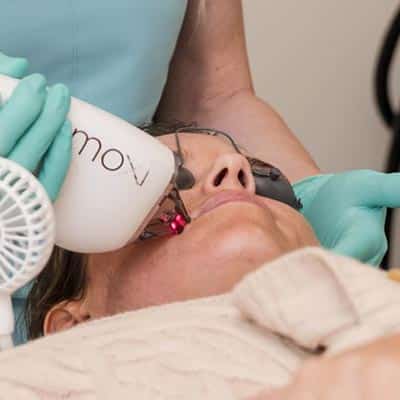Moxi Laser Treatment in Lakewood Ranch FL