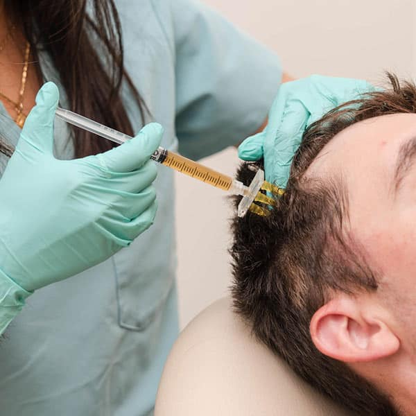 PRF for Hair Loss Treatment