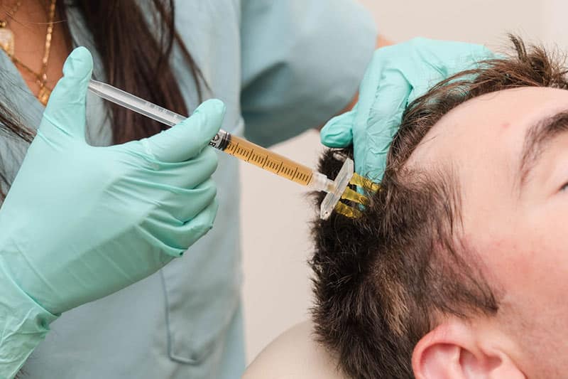 PRF Treatment or Hair Loss