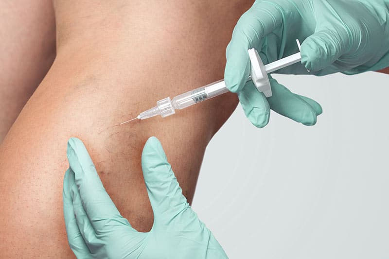Sclerotherapy for Spider Veins