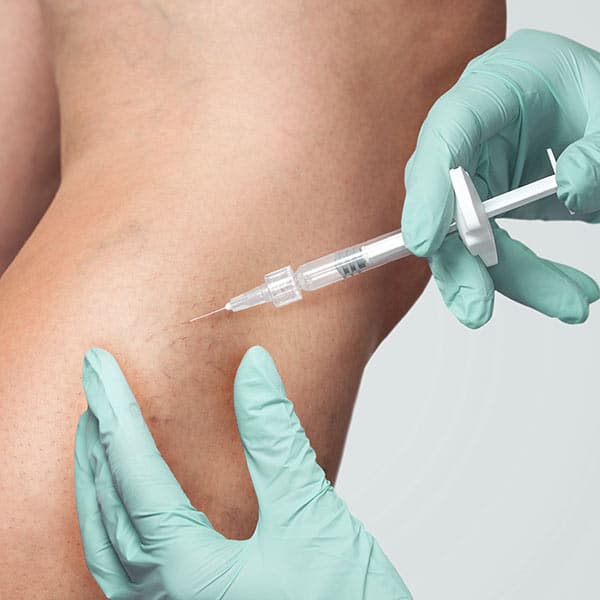 sclerotherapy treatment for spider veins