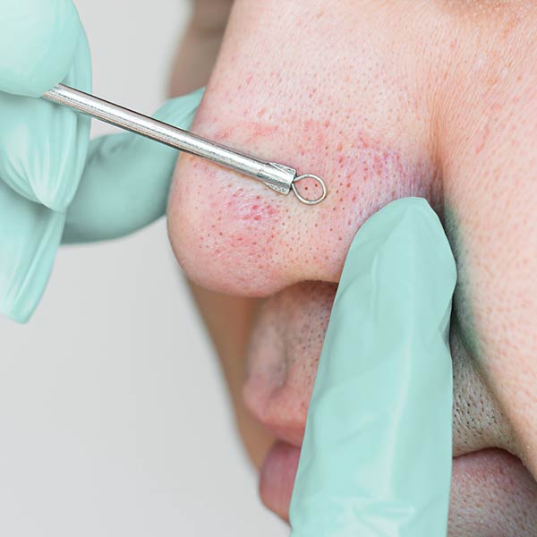 Acne treatments for men