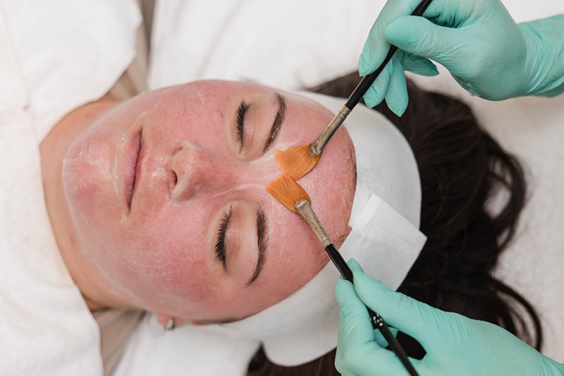 chemical peel