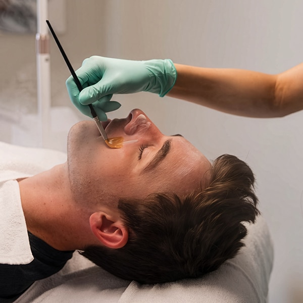 chemical peel in lwr fl