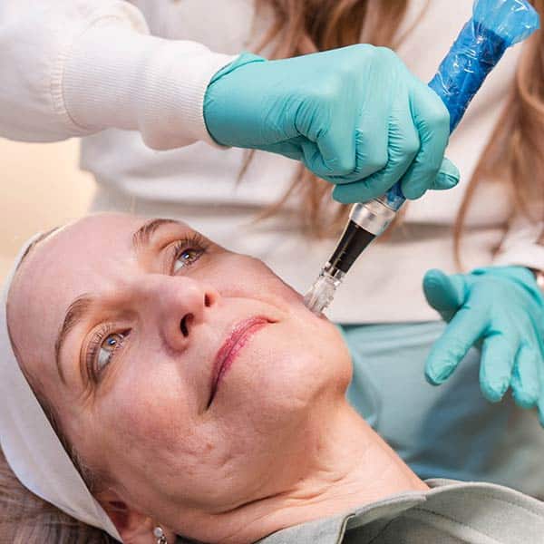 Microneedling with exosomes
