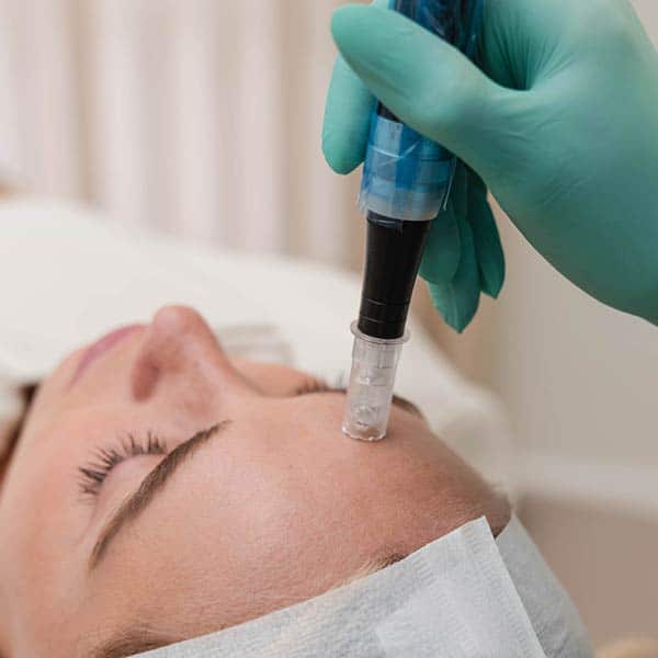microneedling with PDGF+