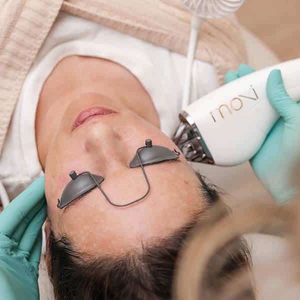 Moxi Laser Treatment