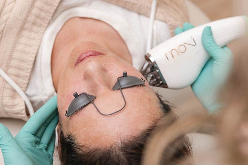 Moxi Laser Treatment
