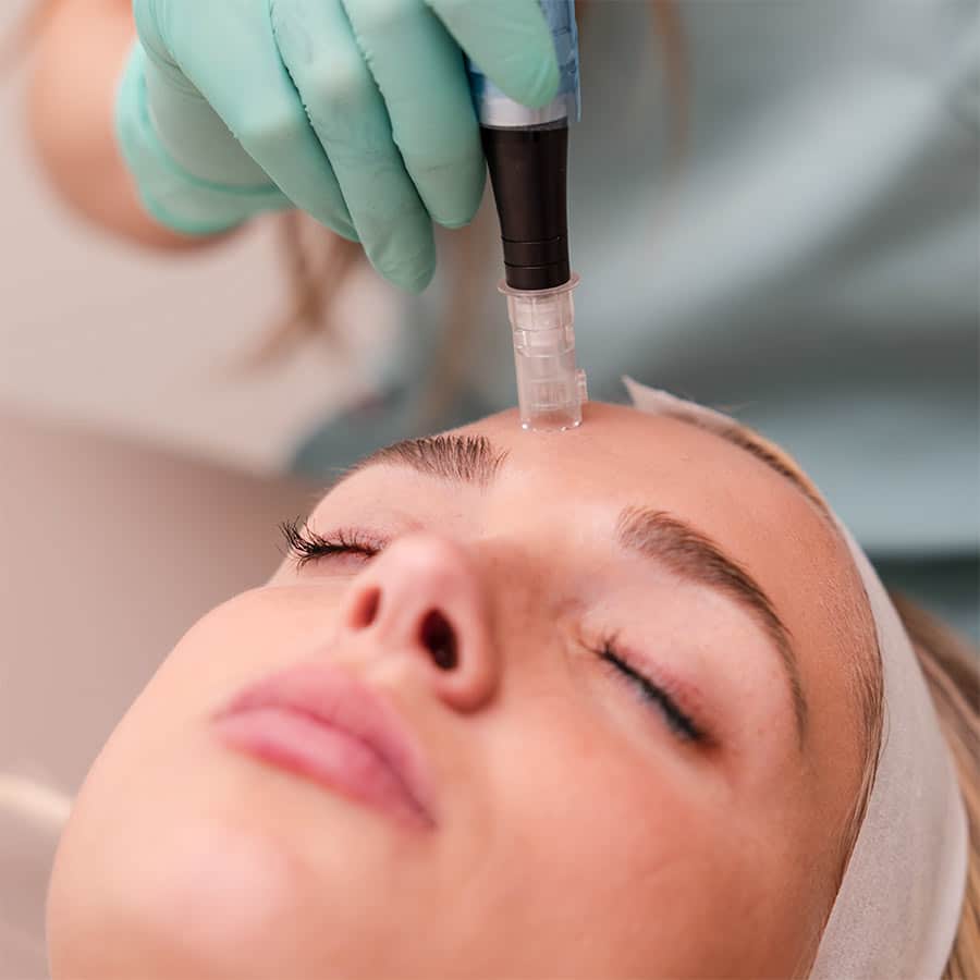 $150 off microneedling packages August 2026 special in Lakewood Ranch Florida