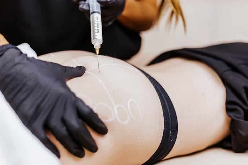 Brazilian Butt Lift BBL Non-Surgical Butt Lift Treatment at Arsenault Aesthetics in Lakewood Ranch Florida
