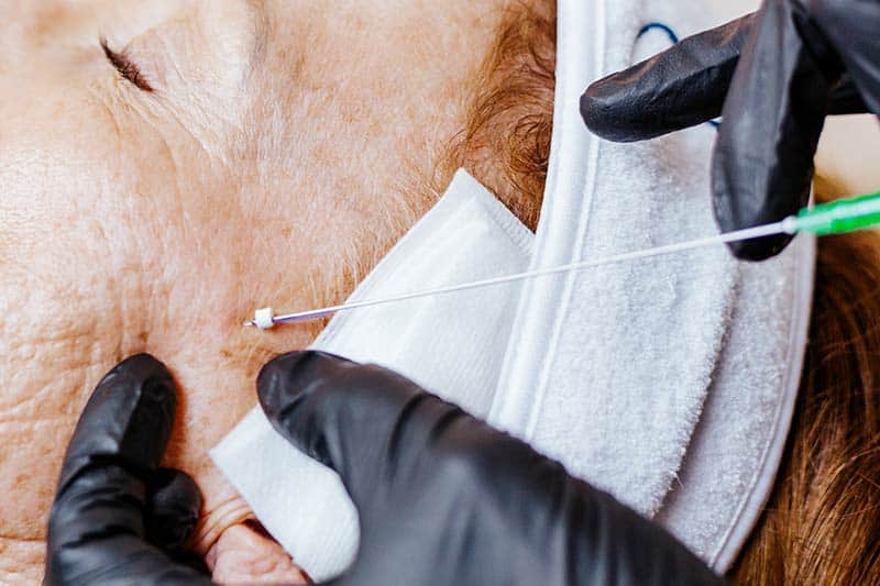 PDO Thread Lift during Thread Lift Treatment in Lakewood Ranch Florida
