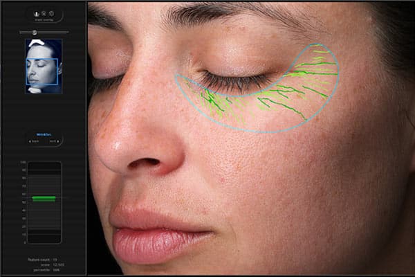 Visia Skin Analysis