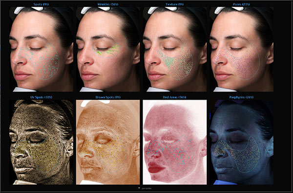 Visia Skin Analysis