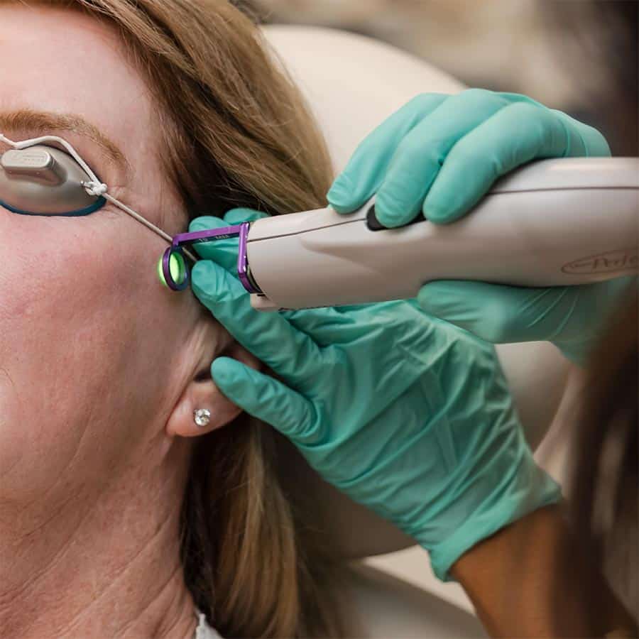 100 off vbeam laser september special in lakewood ranch florida